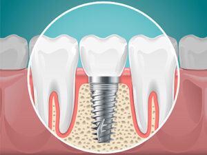 Single Dental Implant Illustration