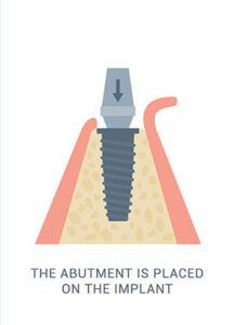 Implant abutment is placed