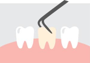 Image depicting a tooth extraction due to infection.