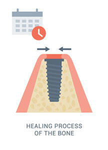 Healing and Osseointegration