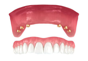 Implant Retained Denture with 6 attachment points