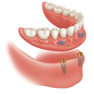 2-Implant Lower Denture